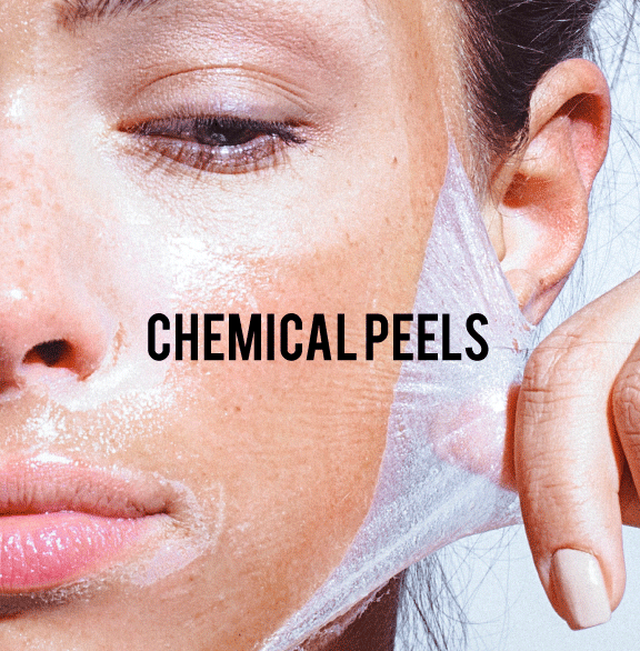 Chemical peels peeling off from face