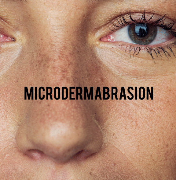 Half face with Microdermabrasion