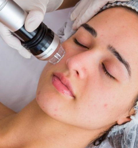 Microneedling treatment process going on
