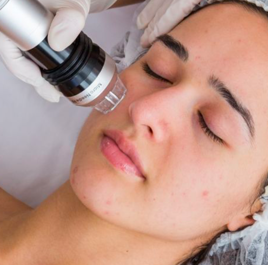 The Benefits of Microneedling Treatment